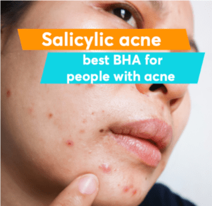 Salicylic Acid for Acne Treatment 1