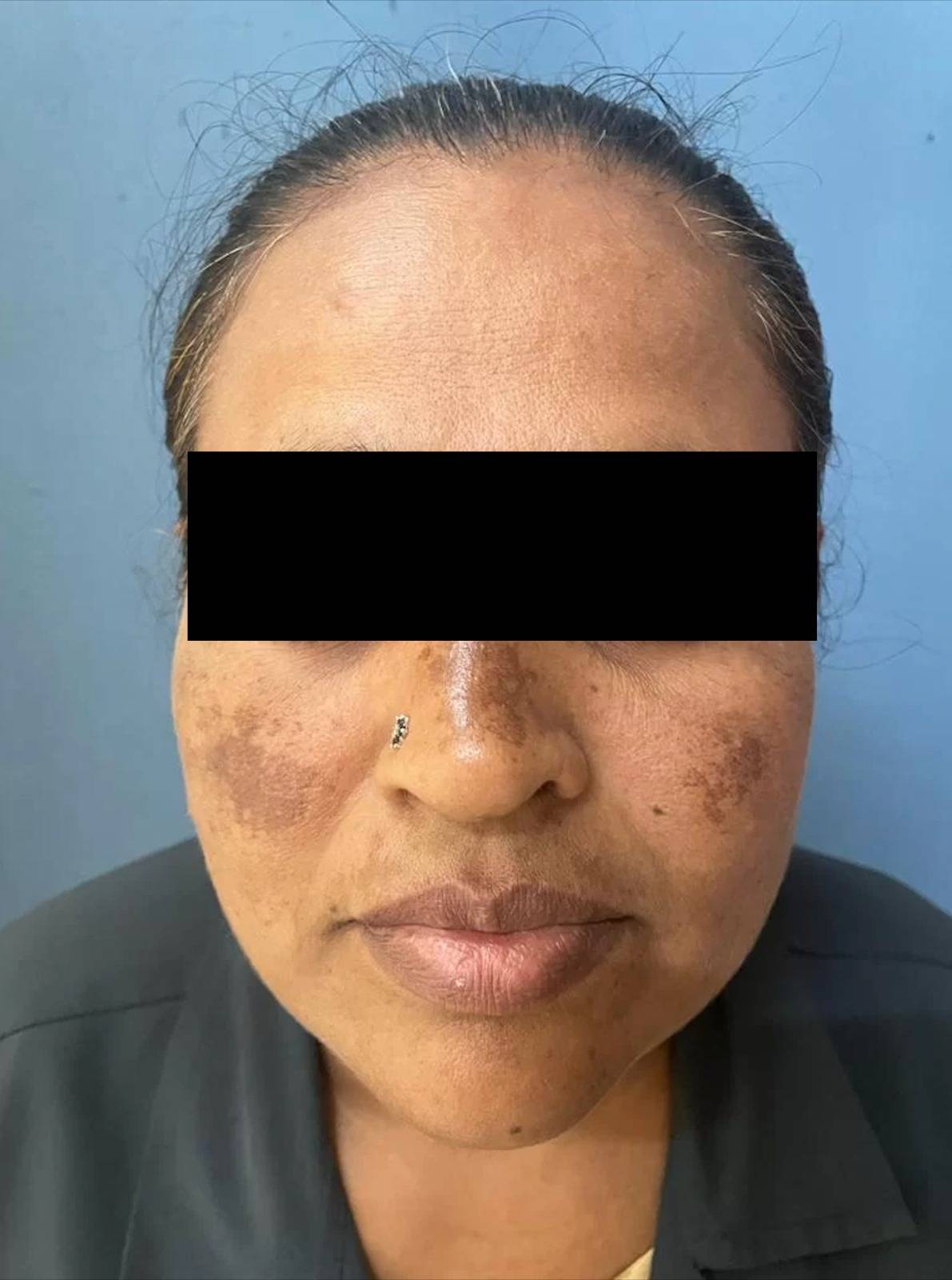 melasma