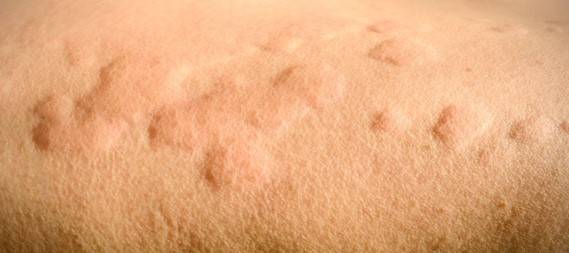 Get ready to tackle the winter blues with these skin-sational tips to keep your skin smiling even in the chilliest of chills! 6 Get ready to tackle the winter blues with these skin-sational tips to keep your skin smiling even in the chilliest of chills! 6