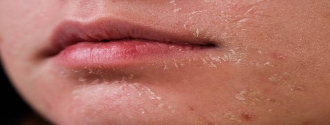 Get ready to tackle the winter blues with these skin-sational tips to keep your skin smiling even in the chilliest of chills! 1 Get ready to tackle the winter blues with these skin-sational tips to keep your skin smiling even in the chilliest of chills! 1