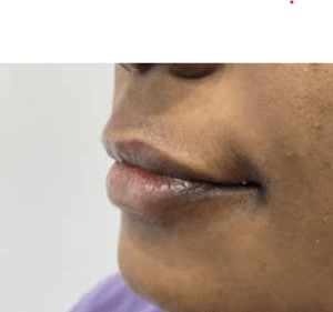 treatment of lip pigmentation