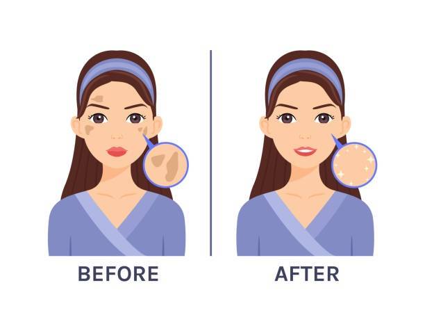 Home care for melasma 1 Home care for melasma