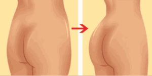 butt augmentation in bangalore