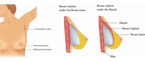 placement-of-breast-implants