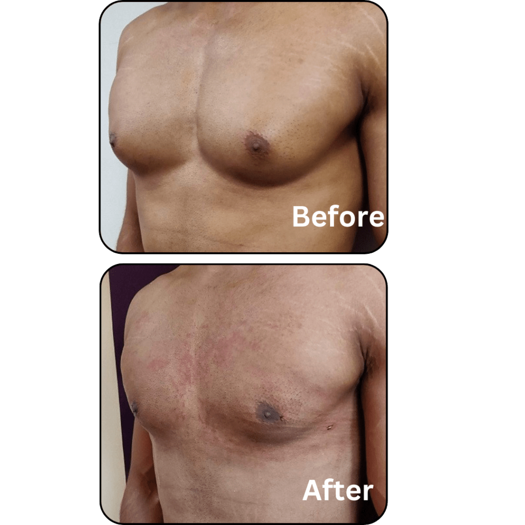 Gynecomastia LP 1 Gynecomastia LP 1
