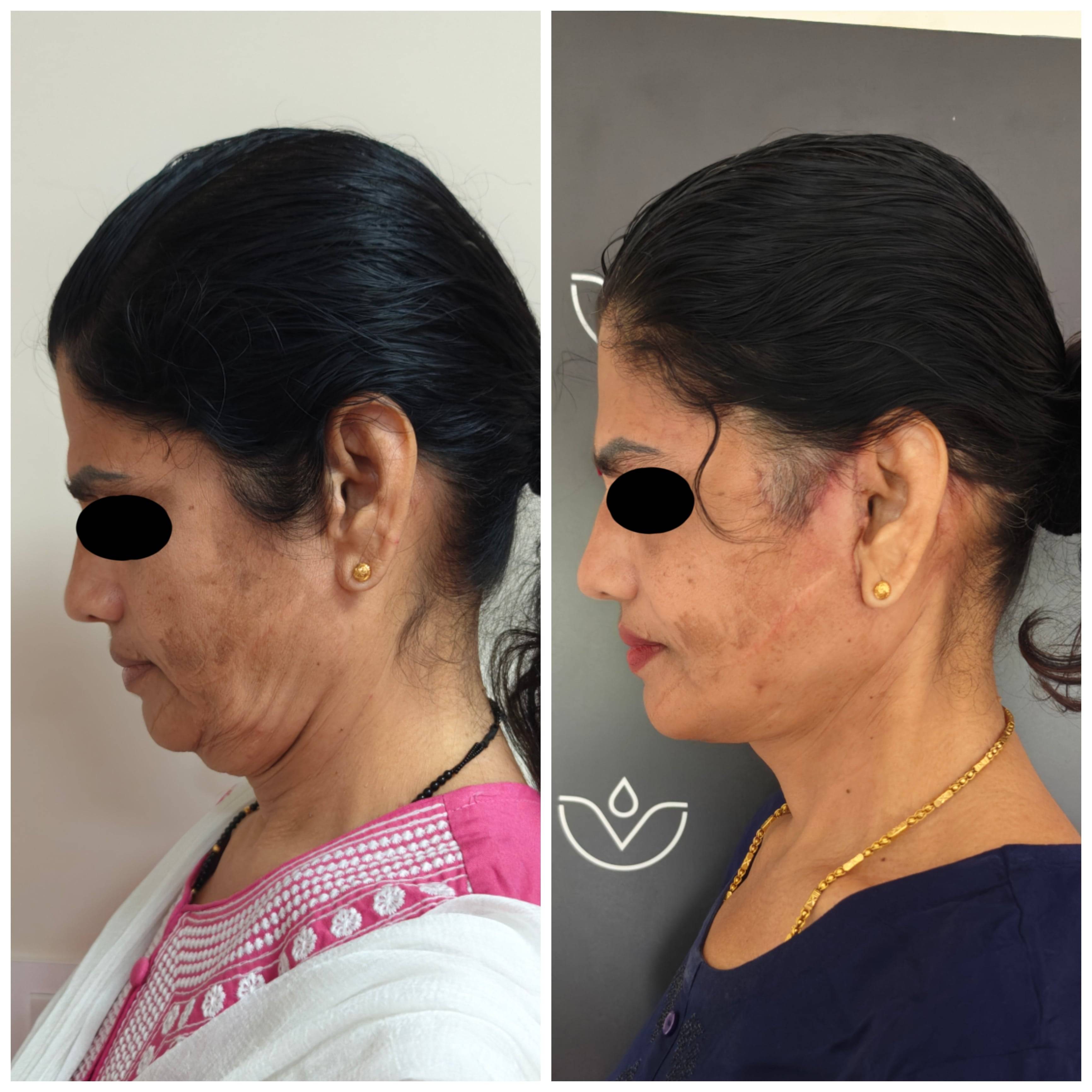 Necklift Facelift Surgery Cost 8