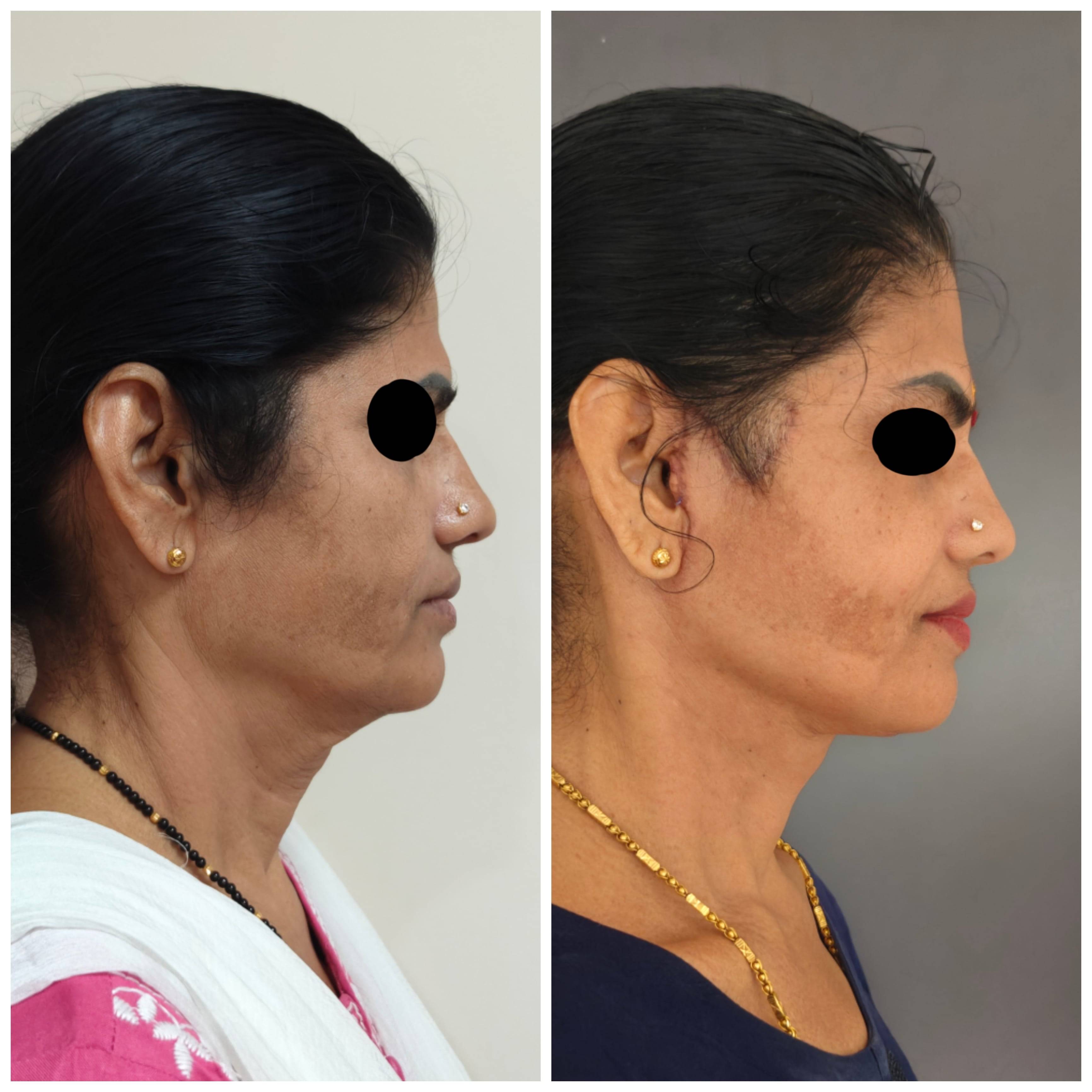 Necklift Facelift Surgery Cost 6
