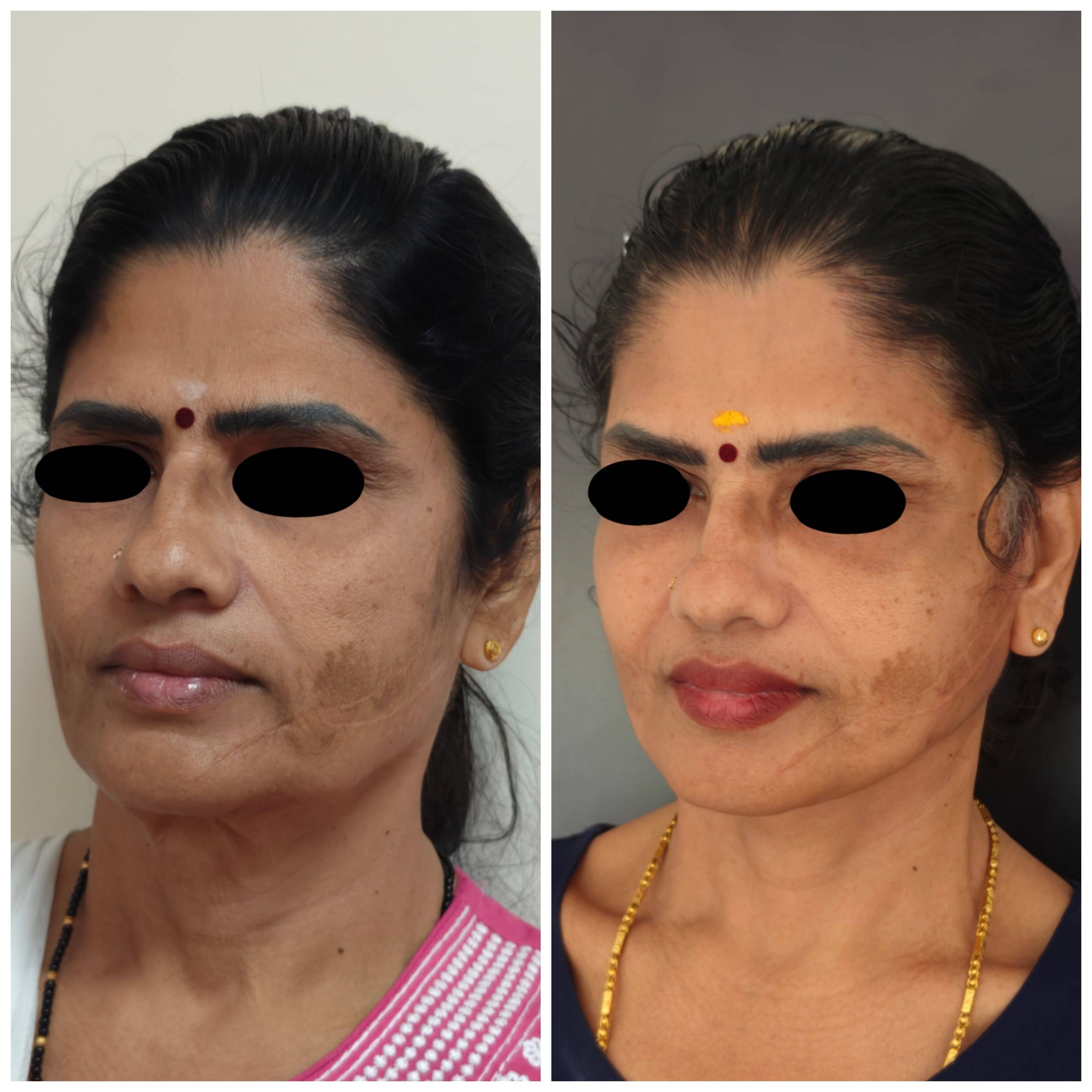 Necklift Facelift Surgery Cost 9