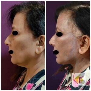 Necklift Facelift Surgery Cost 4