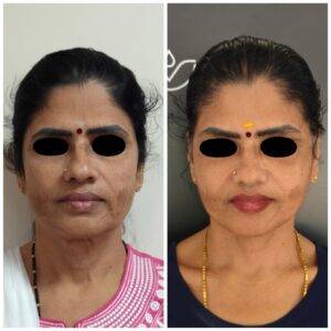 Necklift Facelift Surgery Cost 7