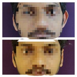 Otoplasty Prominent Ear Surgery Cost 1