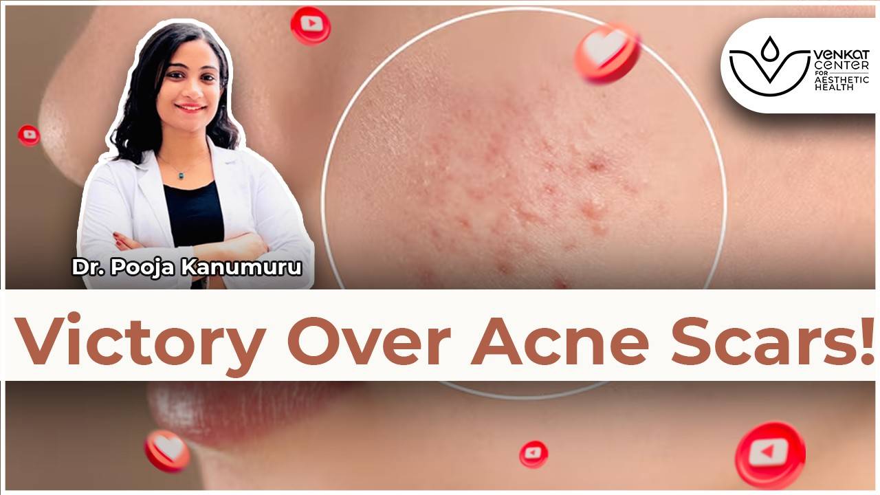 Victory Over Acne Scars Acne Scar Treatments At Venkat Center For Victory Over Acne Scars Acne Scar Treatments At Venkat Center For