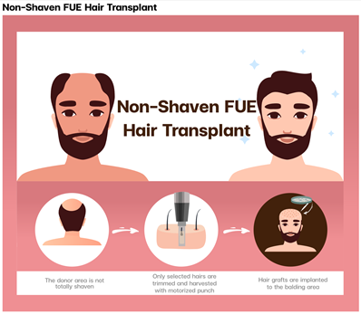 Long Hair FUE hair transplant procedure demonstration