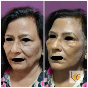Necklift Facelift Surgery Cost 5