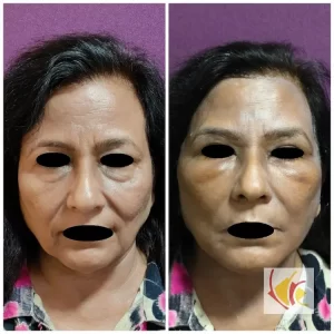 Necklift Facelift Surgery Cost 3