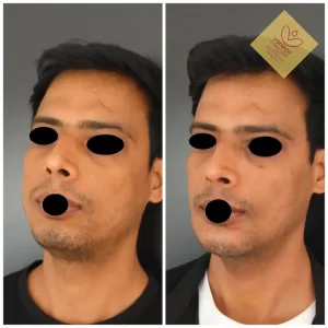 Chin Augmentation in Bangalore 2