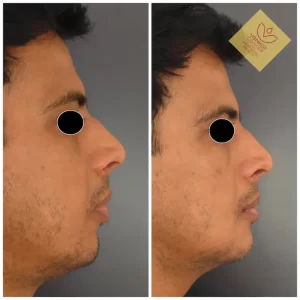 Chin Augmentation in Bangalore 1