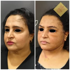 Necklift Facelift Surgery Cost 2