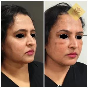 Necklift Facelift Surgery Cost 1