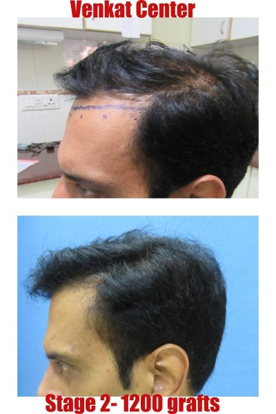 1200 grafts Hair Transplant results at Venkat Center