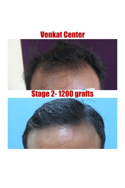 Hair Transplant Results | Before & After Images - The Venkat Center Hair Transplant Results | Before & After Images - The Venkat Center