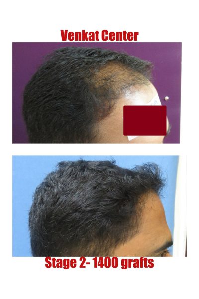 1400 grafts Hair Transplant results at Venkat Center