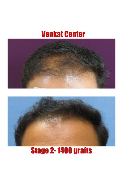 Hair Transplant Results | Before & After Images - The Venkat Center Hair Transplant Results | Before & After Images - The Venkat Center