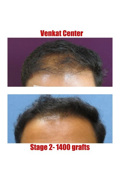 1400 grafts Hair Transplant results at Venkat Center