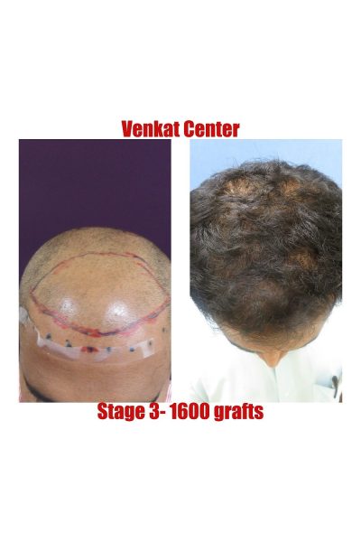 1600 grafts Hair Transplant results at Venkat Center