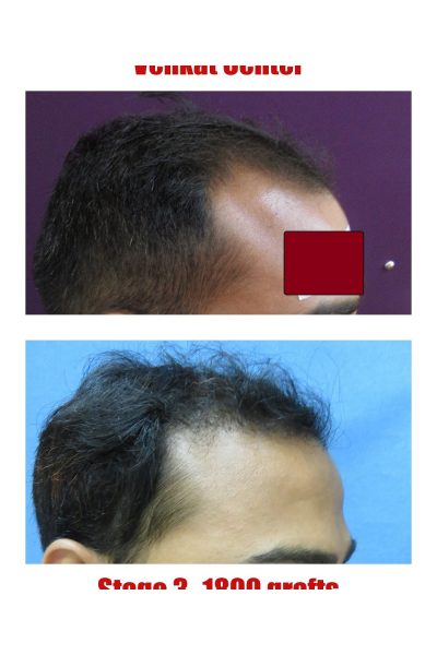 1800 grafts Hair Transplant results at Venkat Center