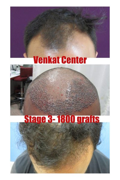 1800 grafts Hair Transplant results at Venkat Center