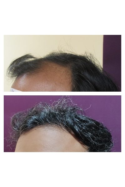2000 grafts Hair Transplant results at Venkat Center