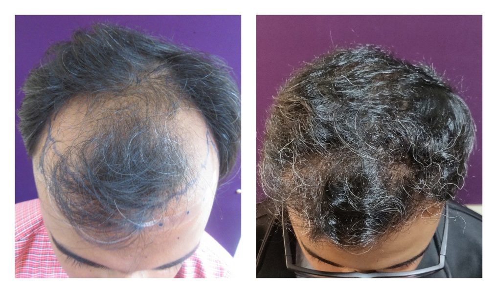 2000 grafts Hair Transplant results at Venkat Center