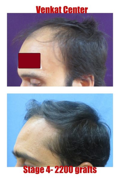 2200 grafts Hair Transplant results at Venkat Center
