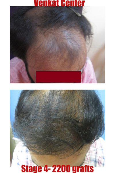2200 grafts Hair Transplant results at Venkat Center