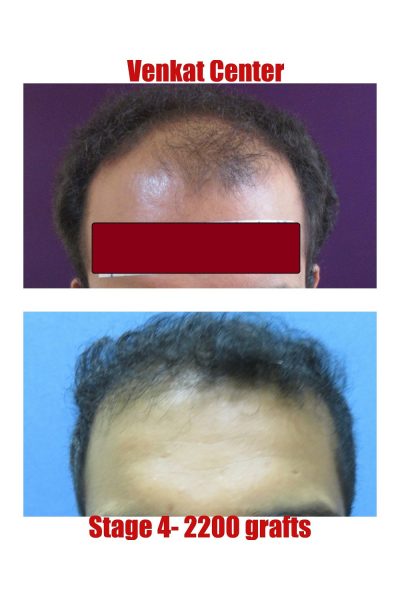 Hair Transplant Results | Before & After Images - The Venkat Center