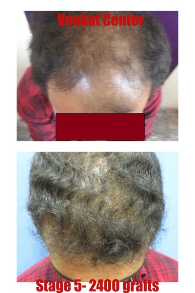 2400 grafts Hair Transplant results at Venkat Center
