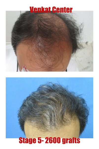Hair Transplant Results | Before & After Images - The Venkat Center Hair Transplant Results | Before & After Images - The Venkat Center