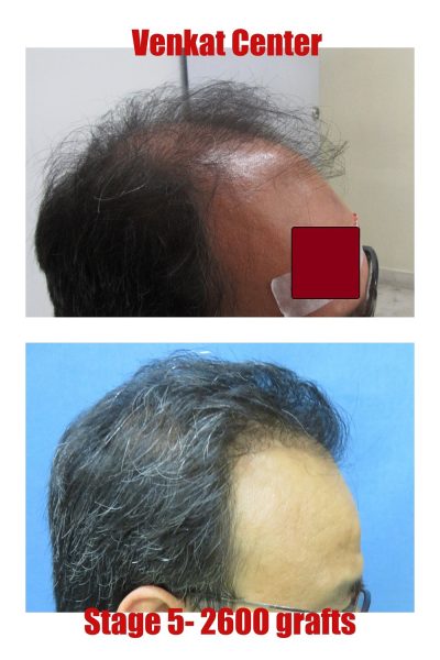 2600 grafts Hair Transplant results at Venkat Center