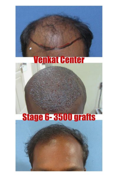 3600 grafts Hair Transplant results at Venkat Center