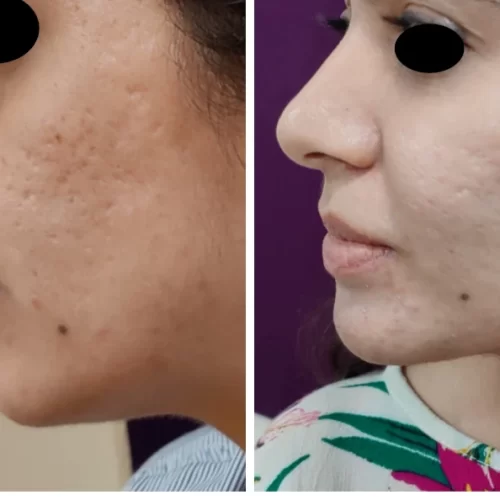 Acne Scars Treatment at The Venkat Center 1