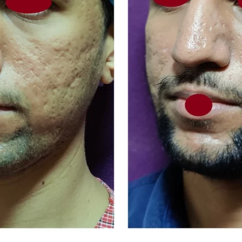 Acne Scars Treatment at The Venkat Center 2