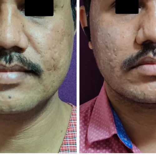 Acne Scars Treatment at The Venkat Center 3