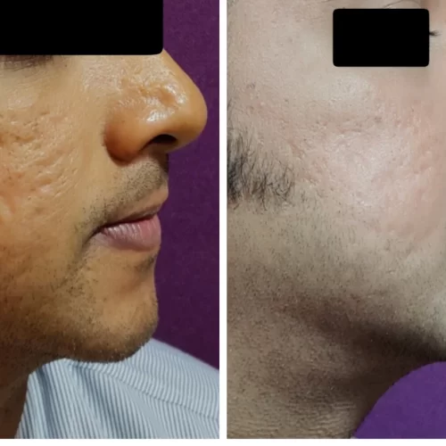 Acne Scars Treatment at The Venkat Center 4
