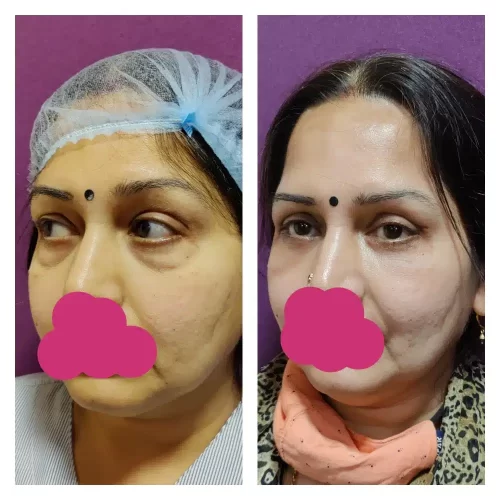 Blepharoplasty Results at Venkat Center 1