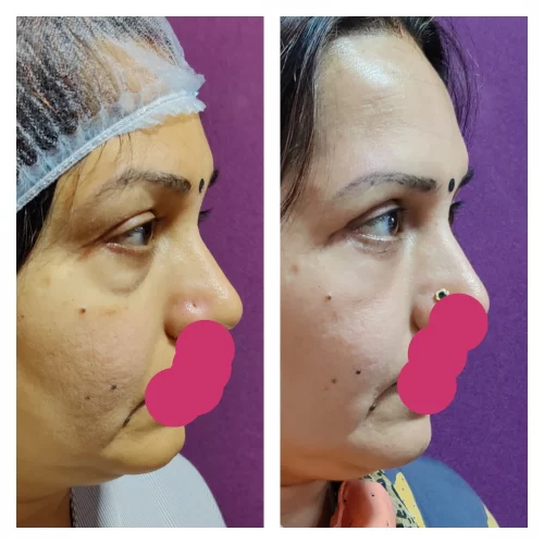 Blepharoplasty Results at Venkat Center 2