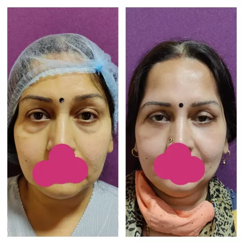 Blepharoplasty Results at Venkat Center