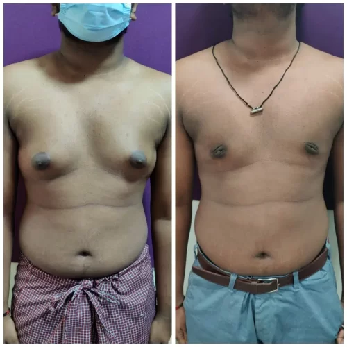 Gynecomastia Treatment Results - Venkat Center Bangalore 1