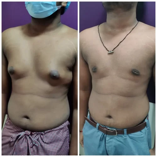 Gynecomastia Treatment Results - Venkat Center Bangalore 2