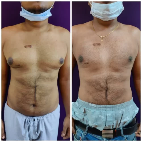 Gynecomastia Treatment Results - Venkat Center Bangalore 3
